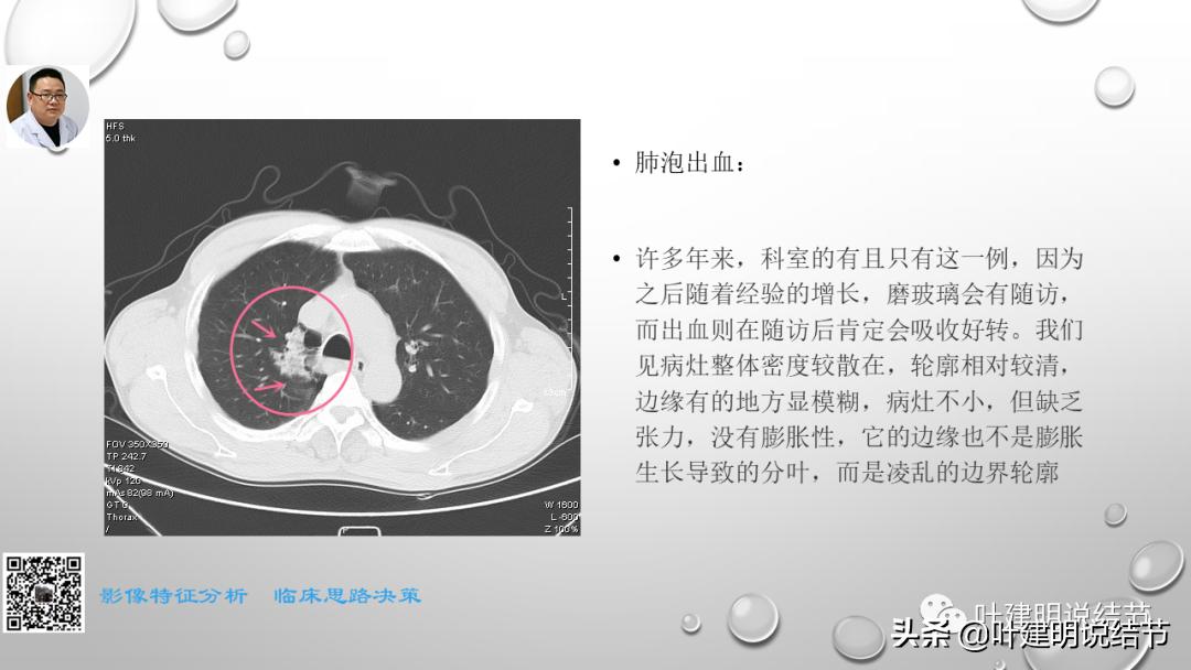 在《一脉阳光》呼吸影像诊断专题培训班上的讲课PPT（第一部分）