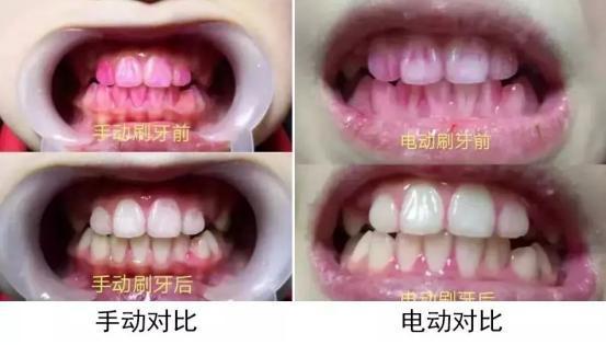 牙刷电动牙刷是智商税吗,u型牙刷是智商税吗