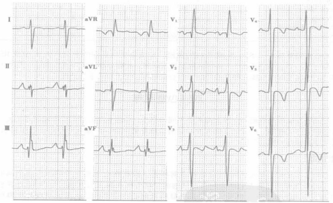 心电图笔记26：QRS波振幅变高，需要想到哪些