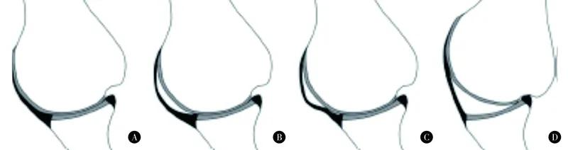 肩关节不稳定患者提问,肩关节习惯性脱臼不治疗的后果