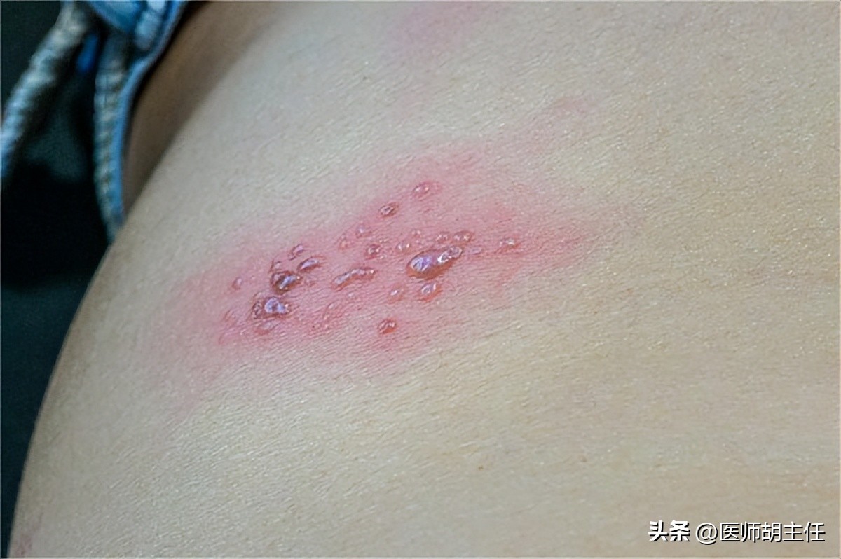 带状疱疹最佳治疗方法,湿疹带状疱疹擦什么好得快