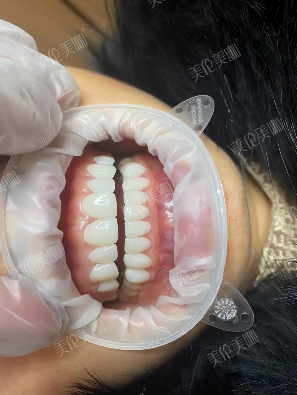 牙缝大做过贴面拆下来还能戴牙套,牙缝大做了两颗全瓷牙现在好后悔