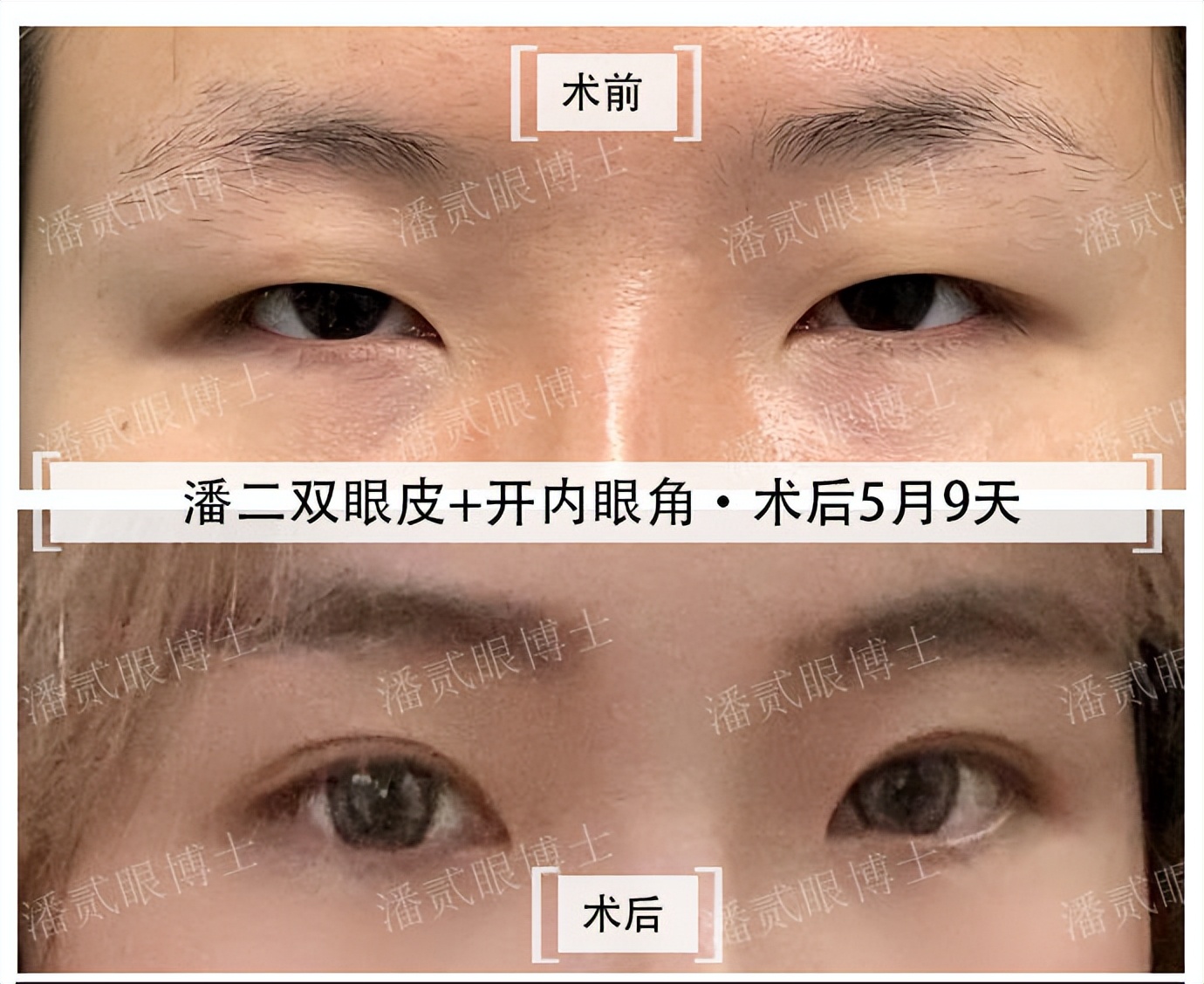 内眦赘皮用手术吗,内眼角内眦赘皮矫正不做手术