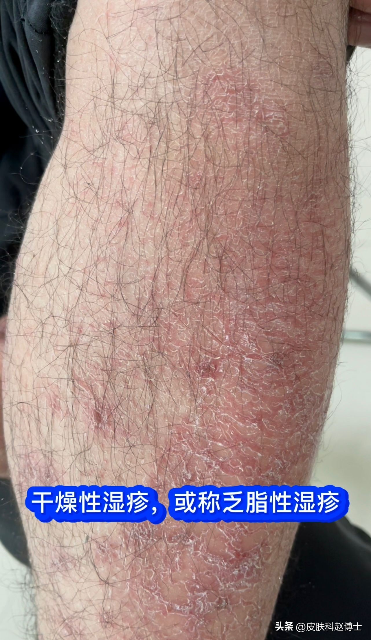 老年人湿疹能洗澡吗,老年人湿疹患处破皮