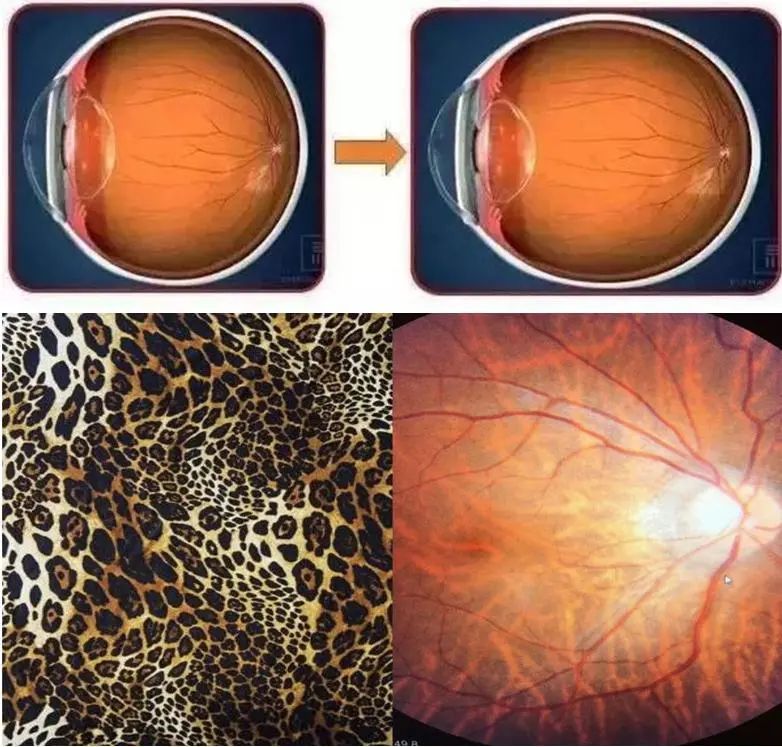 高度近视眼底黄斑病好治吗,高度近视检查眼底就行了吗