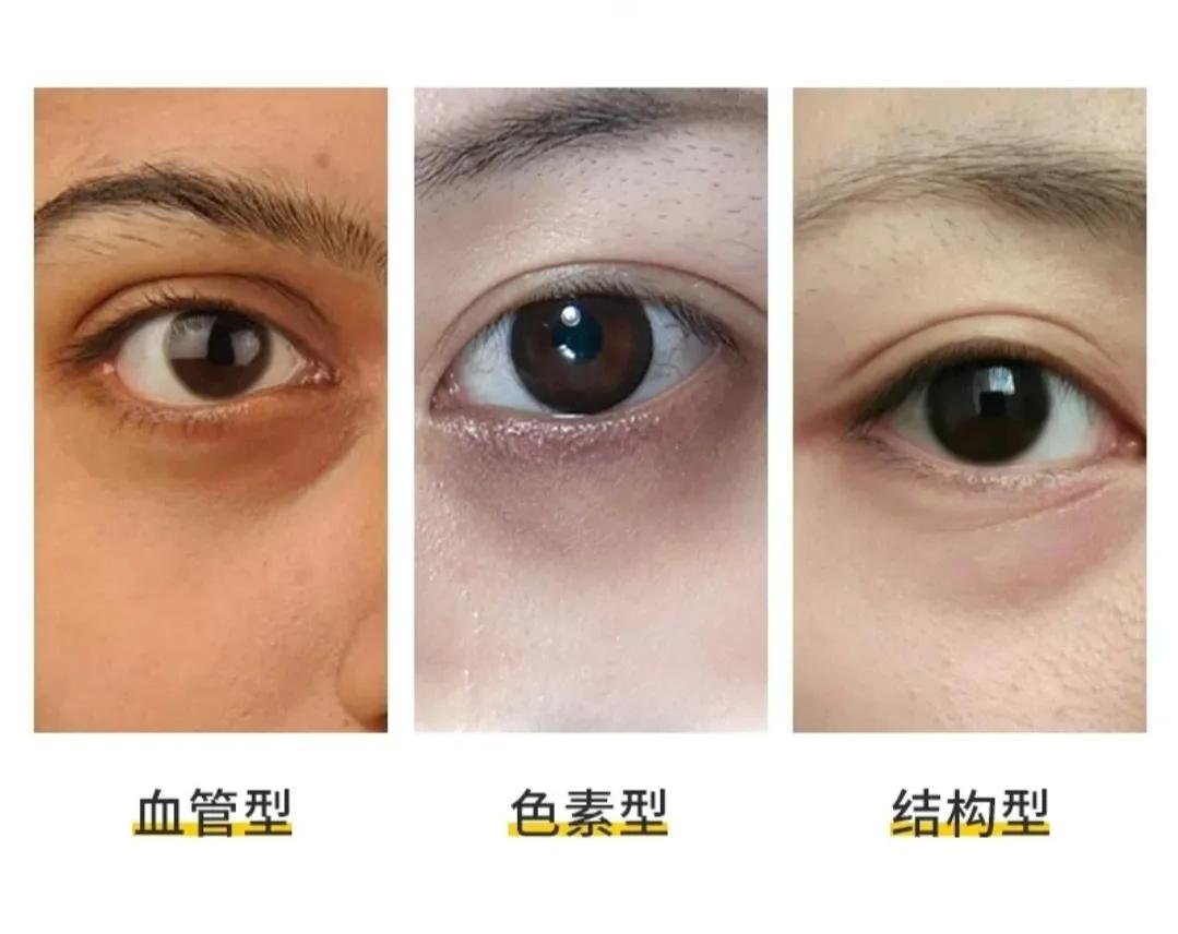 3种类型的黑眼圈怎么改善,混合型黑眼圈是身体出现什么问题