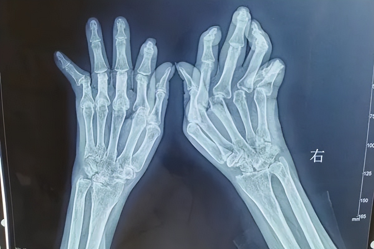 类风湿如何能治好可以泡脚吗,艾灸治好了类风湿