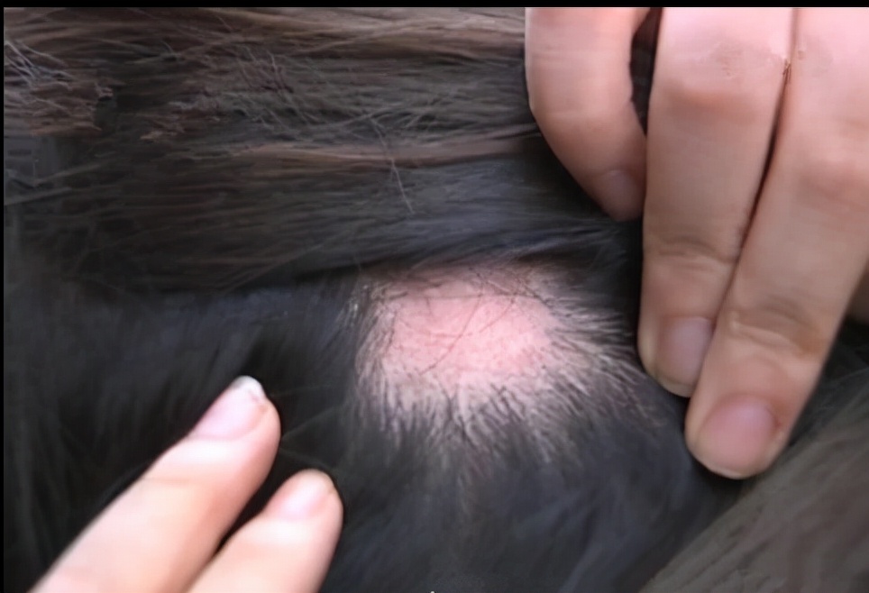 因为染发，我秃了顶.....