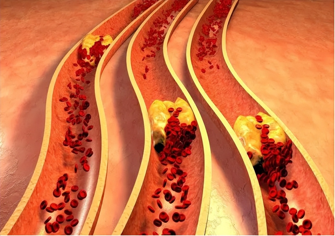 睡觉时腿抽筋是缺钙还是血脂高,睡觉时突然腿抽筋是缺钙导致的吗