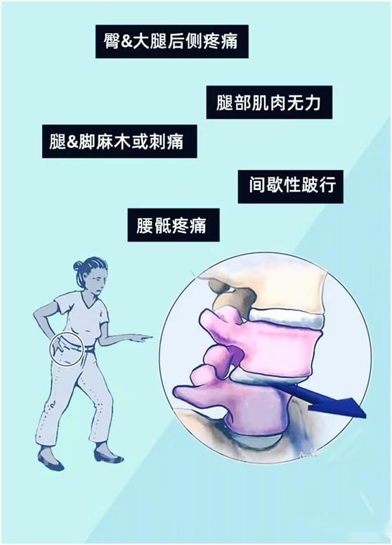 腰椎滑脱的病因,腰椎滑脱症最常见的鉴别诊断