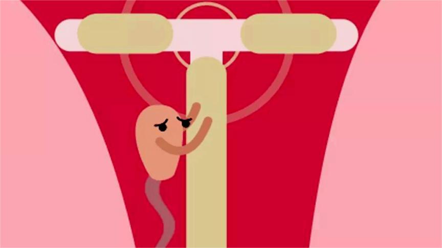 节育环在女性体内会发生哪些变化,女性节育环多少年必须取出来