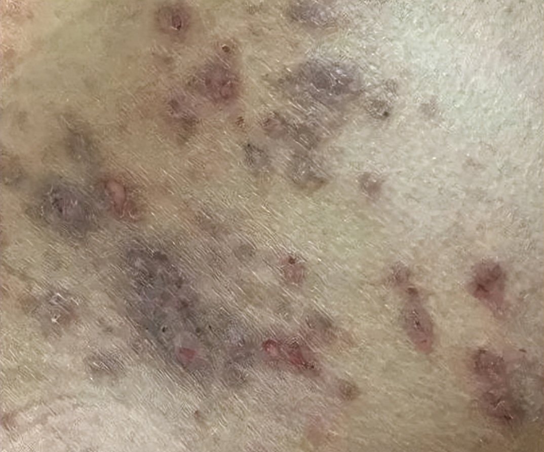 把阴虱用镊子找出来可以吗,阴虱是怎么通过性传播的