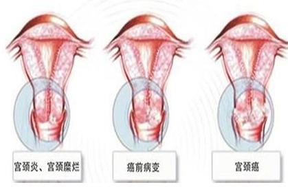 阴道炎到宫颈炎的演变及诊治策略