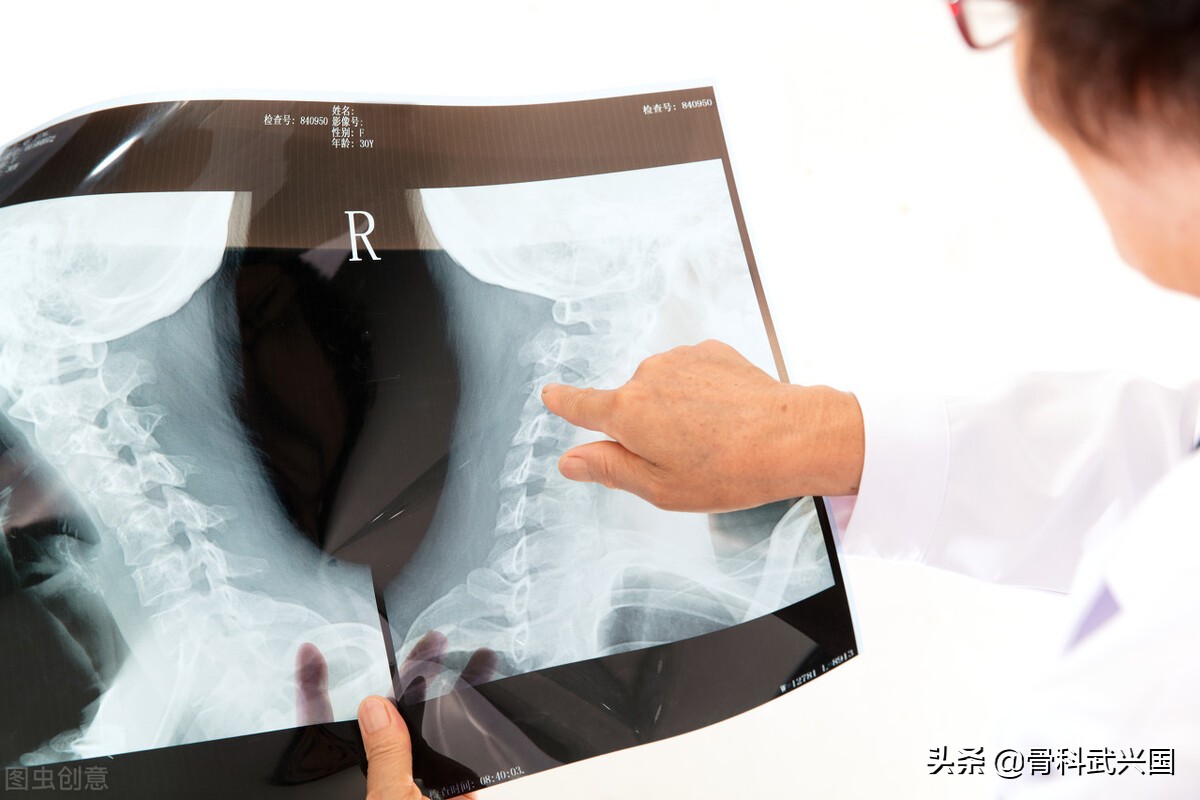 骨刺的非手术治疗有哪些方法？