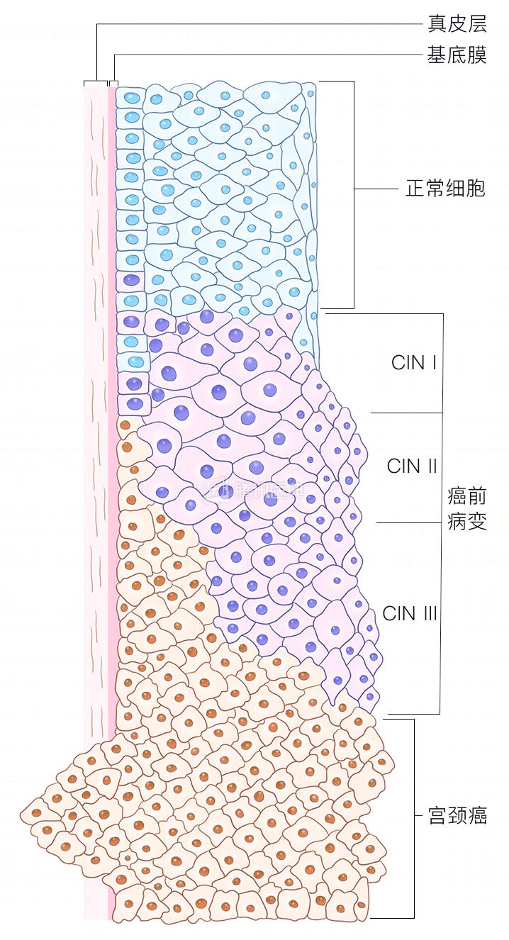 妇科hpv活检要割肉吗,妇科内检需要夹肉化验吗