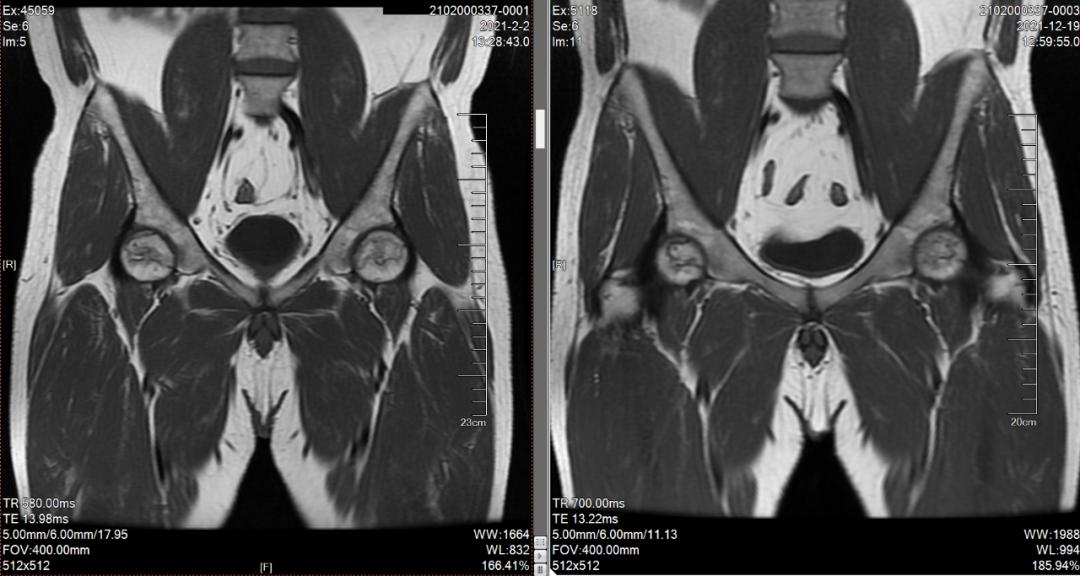 用激素引起股骨头坏死怎么办,因激素药引发的股骨头症状