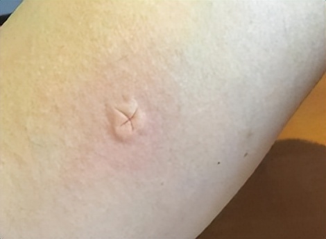 被蚊子咬掐十字止痒法,被蚊子叮咬后掐十字有用吗