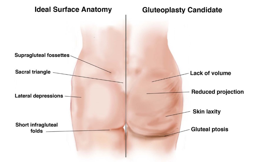 *裤内**为啥老往屁股沟里跑？不单单是*裤内**的问题，你的屁股也没长对