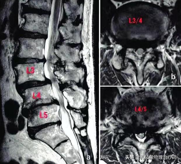 腰椎管狭窄引起的腰腿疼怎么办,腰椎管狭窄引起腰痛腿痛怎么办