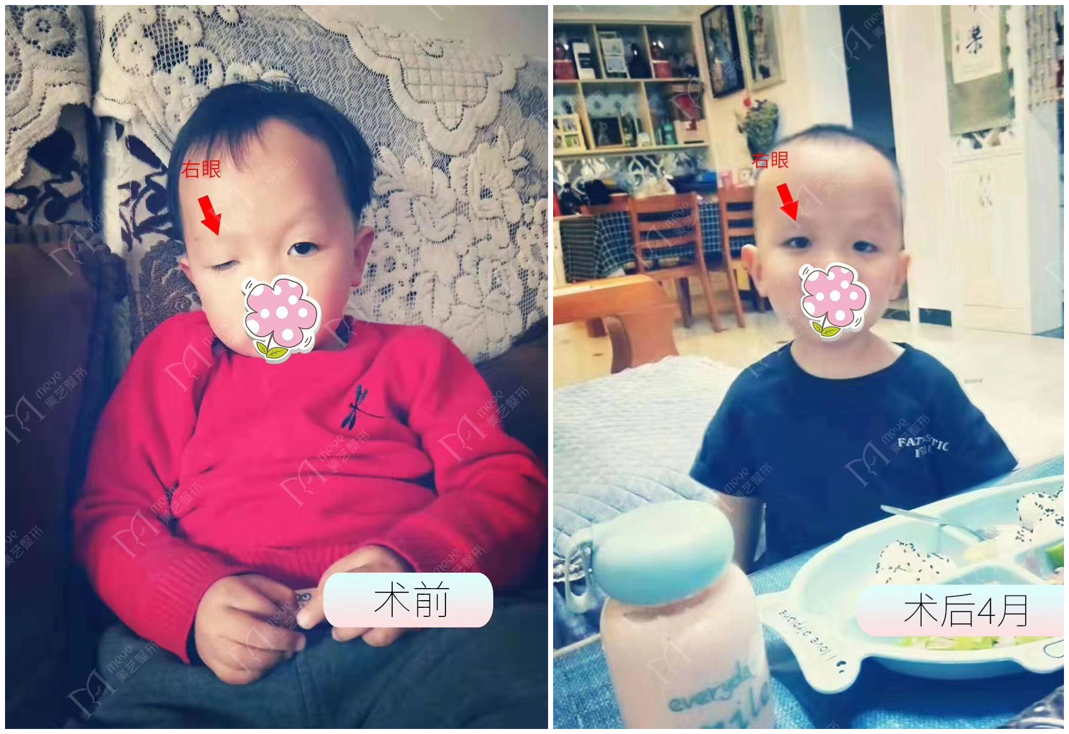 儿童上睑下垂怎么矫正,有什么方法可以帮助孩子上睑下垂