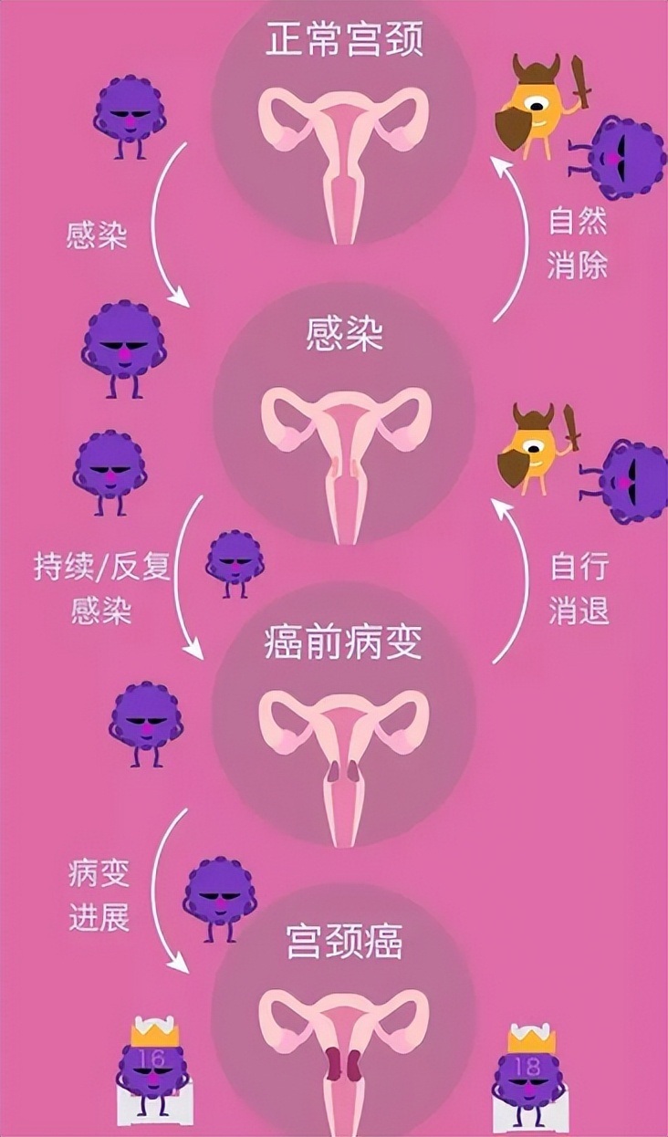 宫颈癌放疗时的注意事项,宫颈癌根治性放疗方案