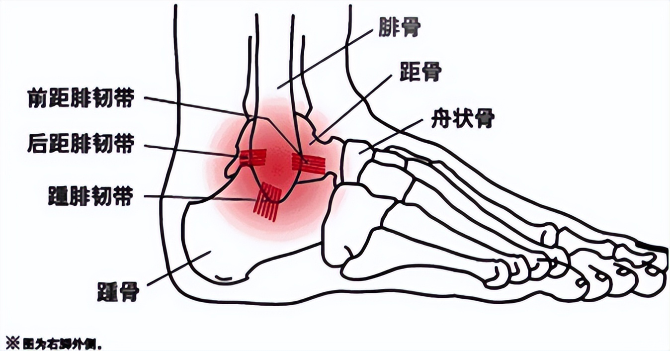 踝关节韧带损伤病历模板,踝关节外侧韧带损伤发病原因