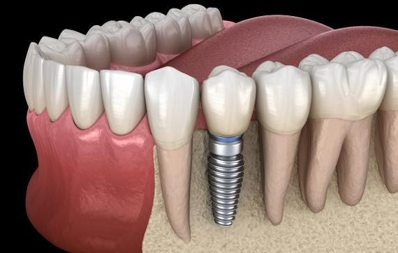 缺牙时间久镶牙位置不够怎么办,缺牙太久局部矫正