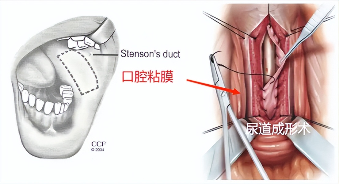排尿困难是哪里出了问题,男性尿道狭窄排尿有什么症状