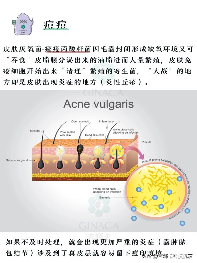 如何祛痘妙招,最简单高效祛痘方法