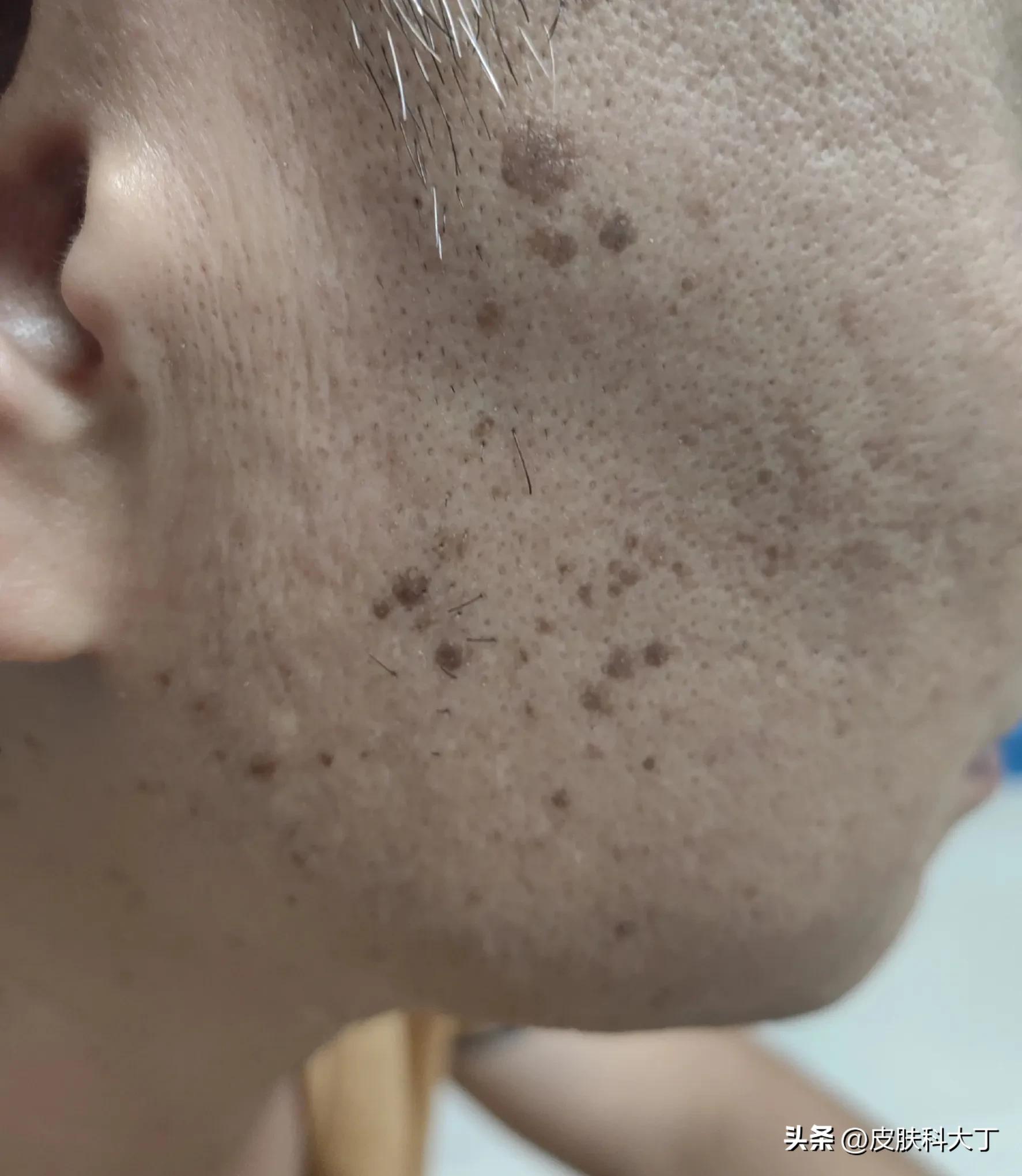 脸上老年斑和黑色素瘤有什么区别,脸上长黑色素斑慢慢就变成黑痣了