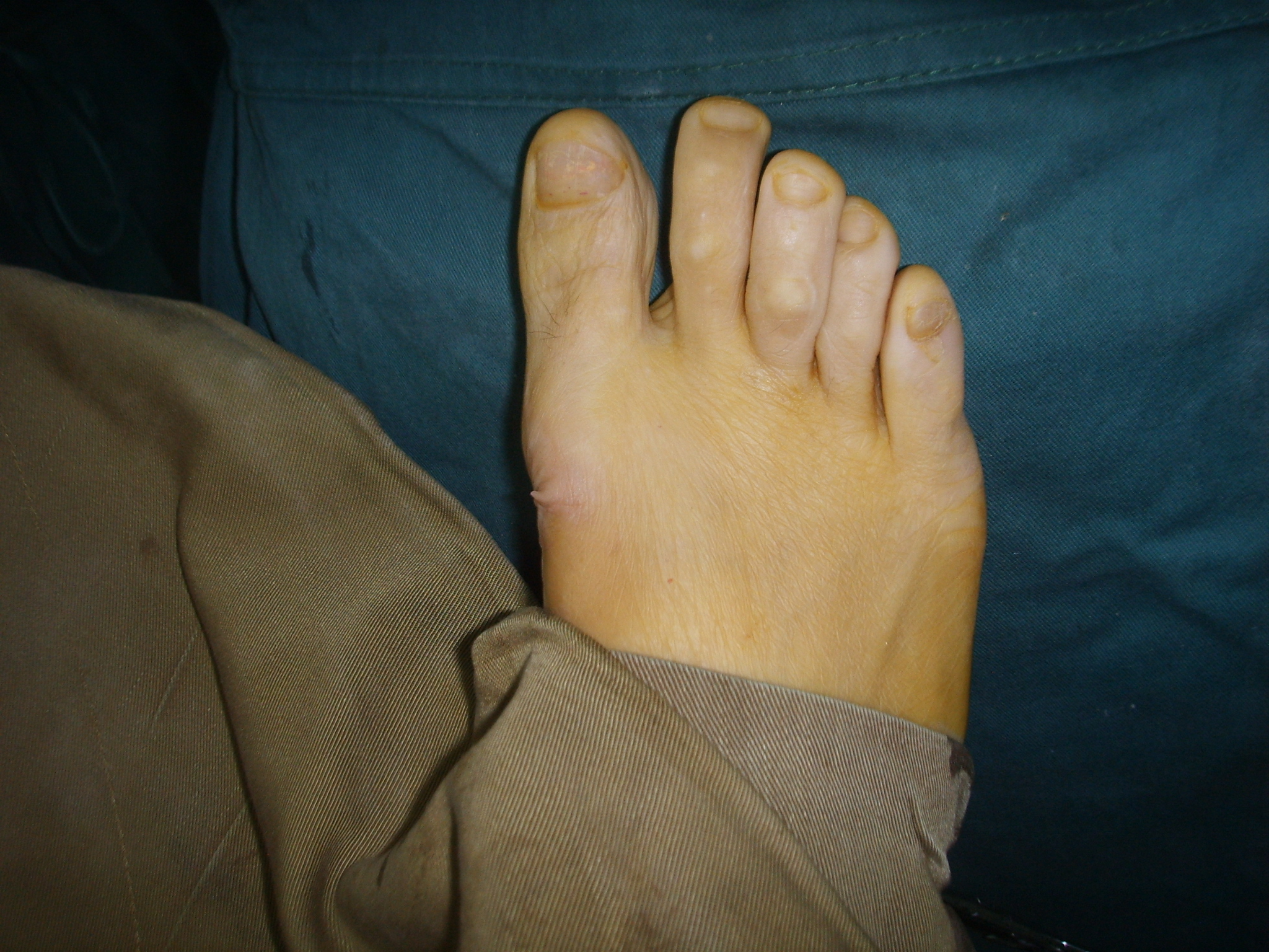 轻度的拇外翻医院有治疗的方法吗,为什么轻度拇外翻不建议做手术