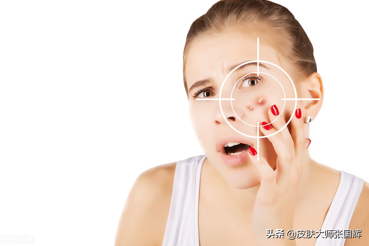 各种痘痘类型及治疗方法,各种痘痘类型治疗方法