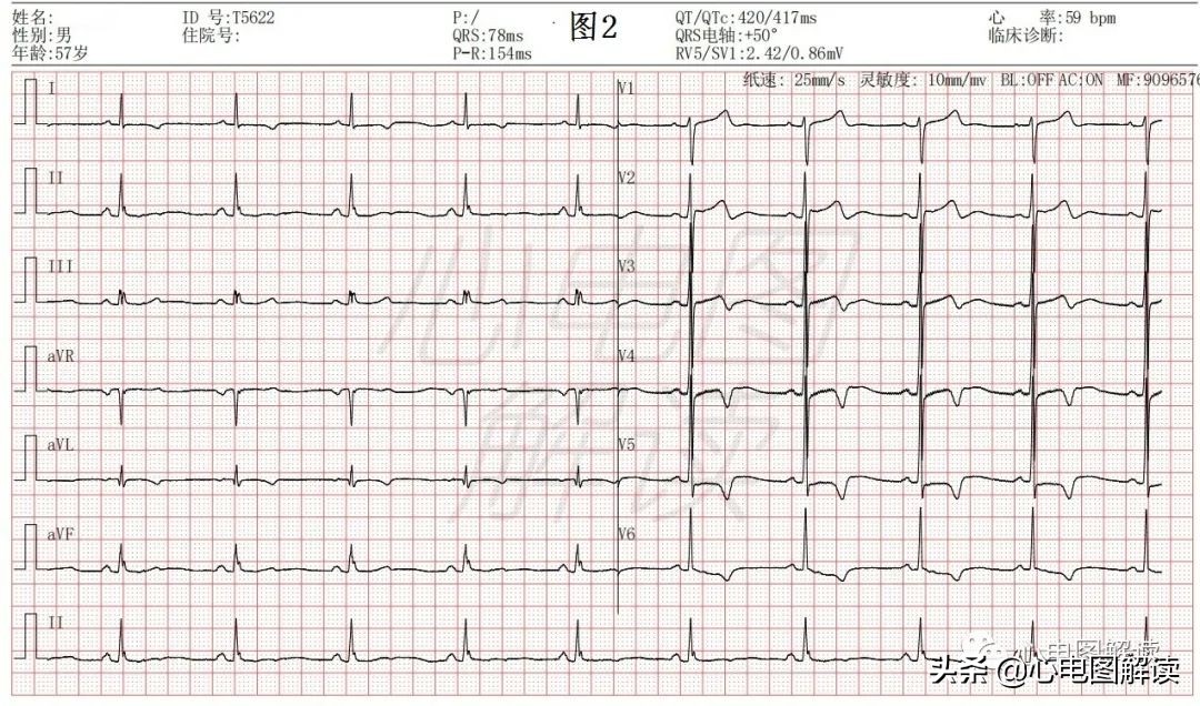 左室面高电压心电图诊断要点,左室高电压是正常吗