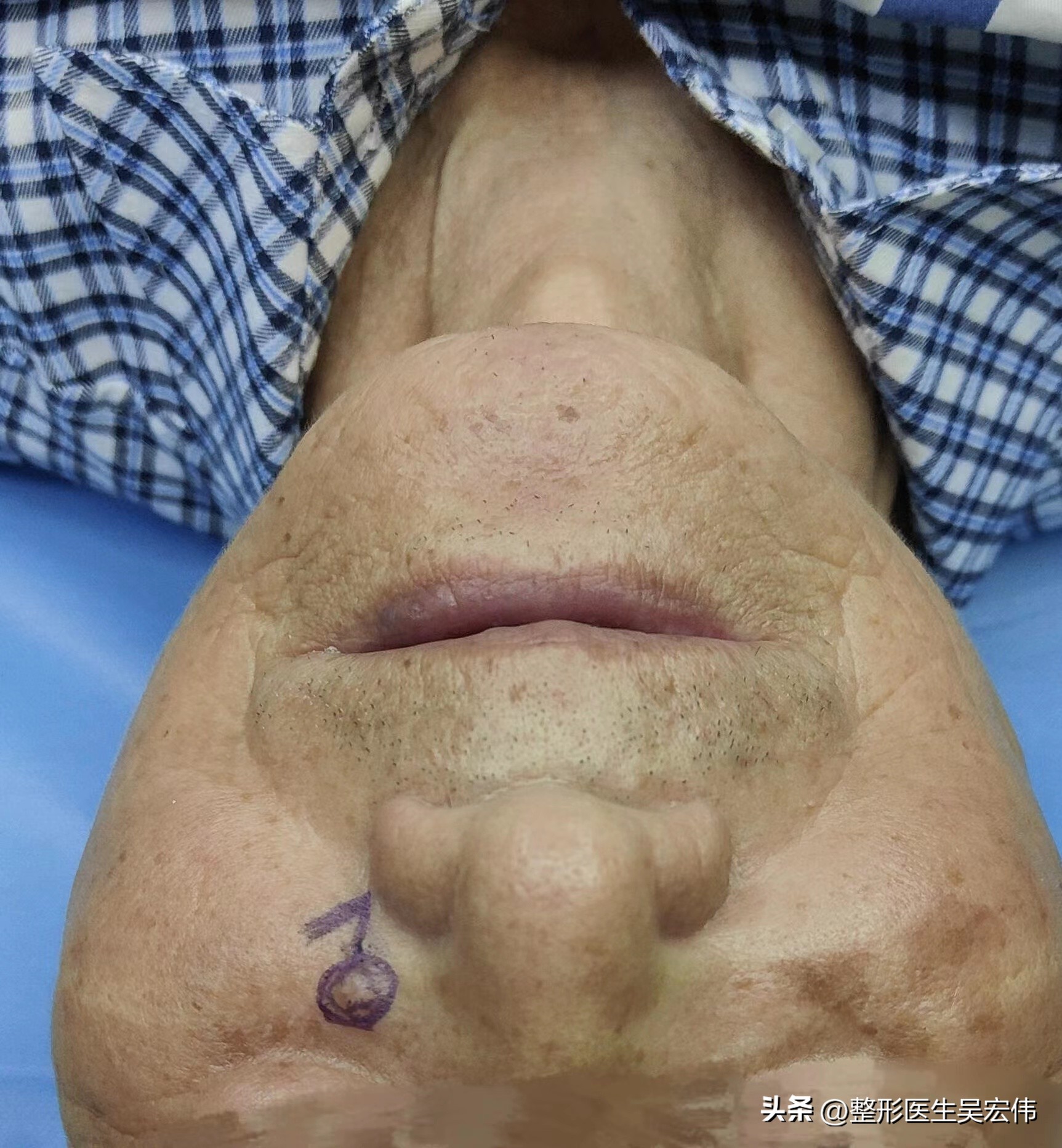 面部痣切除缝合不平整,面部痣可以去掉吗