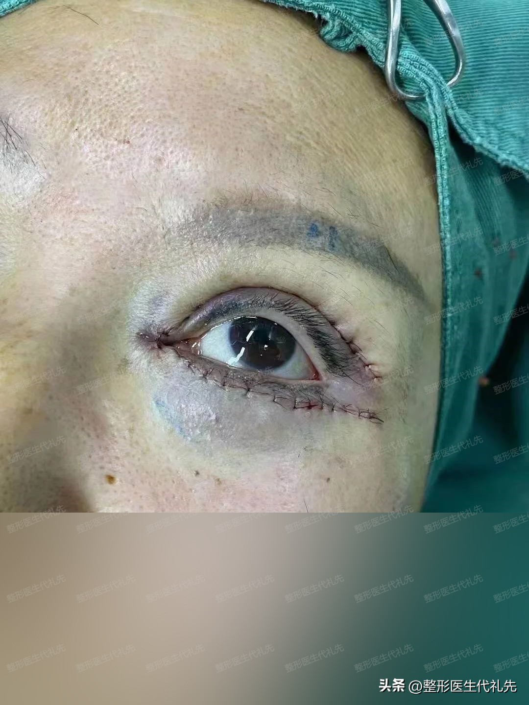 55岁女士做双眼皮能转运吗,北京双眼皮眼袋手术