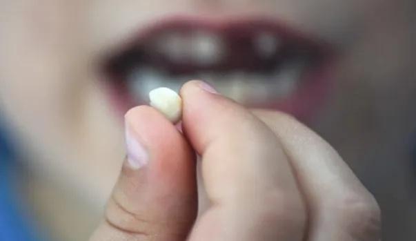 大牙崩掉一小块怎么办,补过的牙侧面被崩掉了一块怎么办