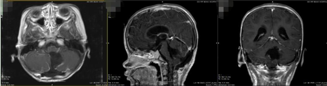 孩子恶心要警惕四种病,孩子脑肿瘤造成恶心呕吐