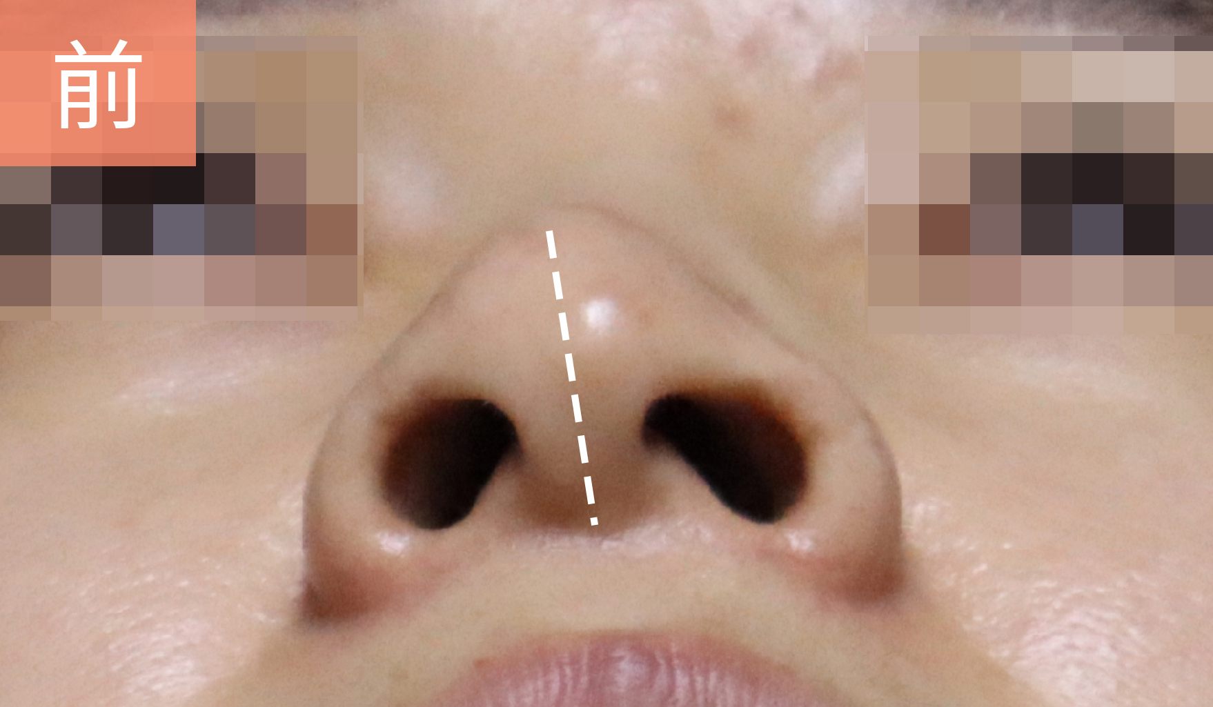 北京八大处整形医院歪鼻矫正,北京同仁医院鼻科知名专家排名