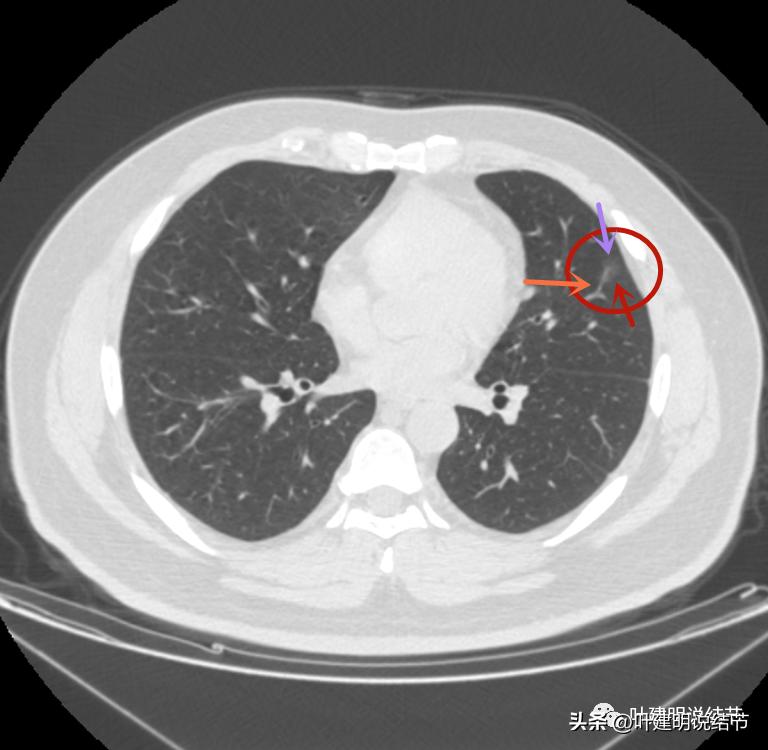 如何判断肺磨玻璃结节是高危结节,肺上有混合磨玻璃结节要注意什么