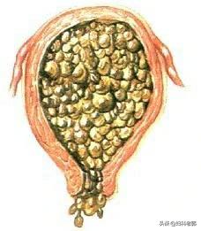 葡萄胎容易怀上怪胎吗,葡萄胎是不是怪胎