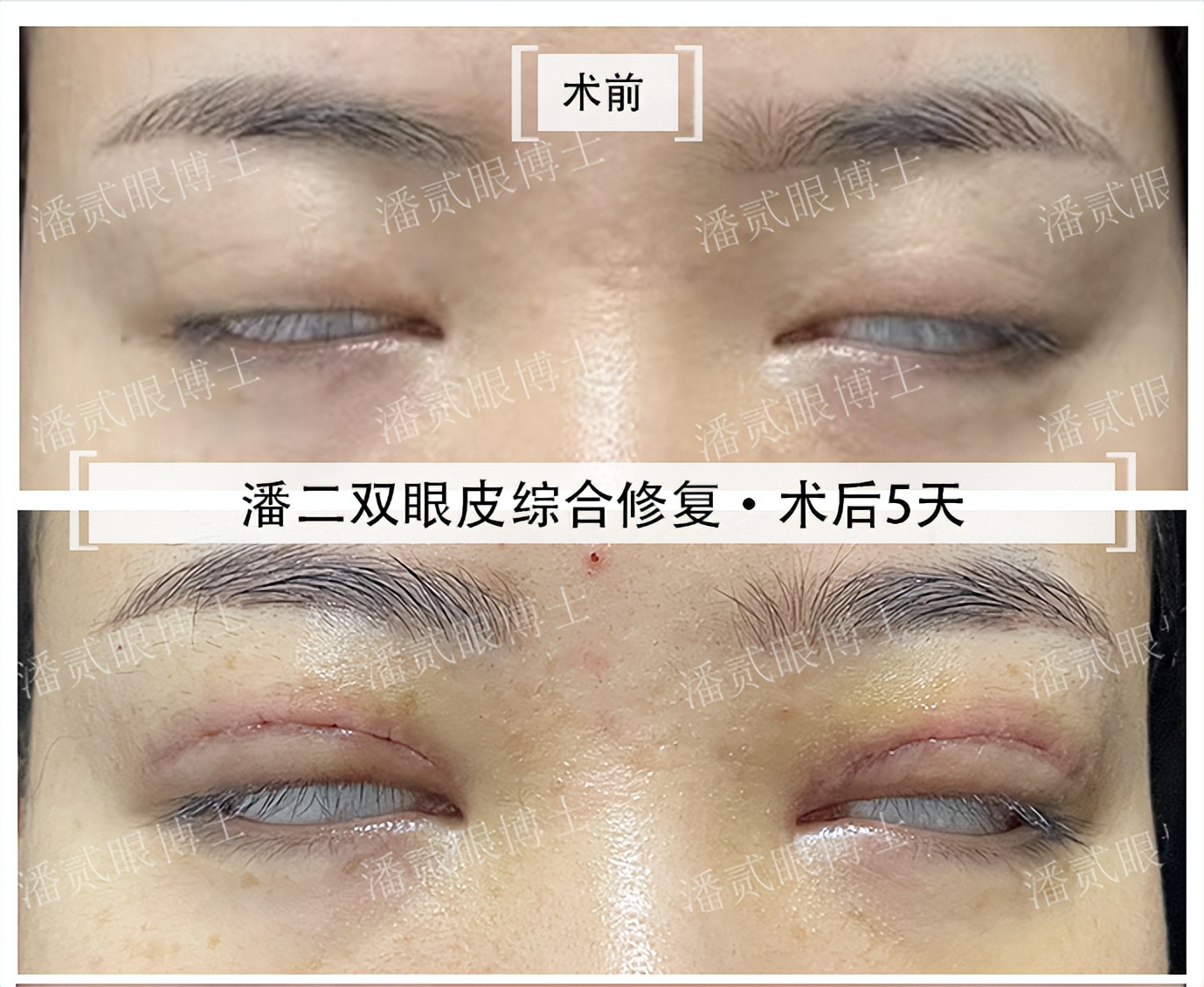 整容后眼睛不能闭合,整容失败眼睛无法闭合