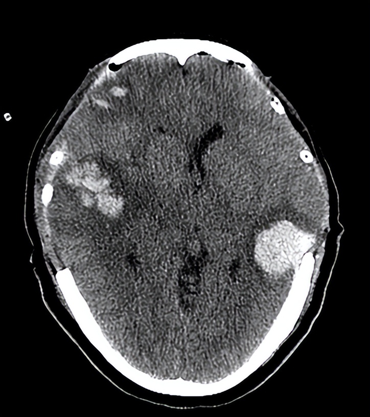 医院成功救治重型颅脑患者,特重型颅脑损伤治愈案