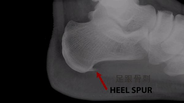 足跟痛筋膜炎最佳的治疗方法,足跟痛和足底筋膜炎康复治疗