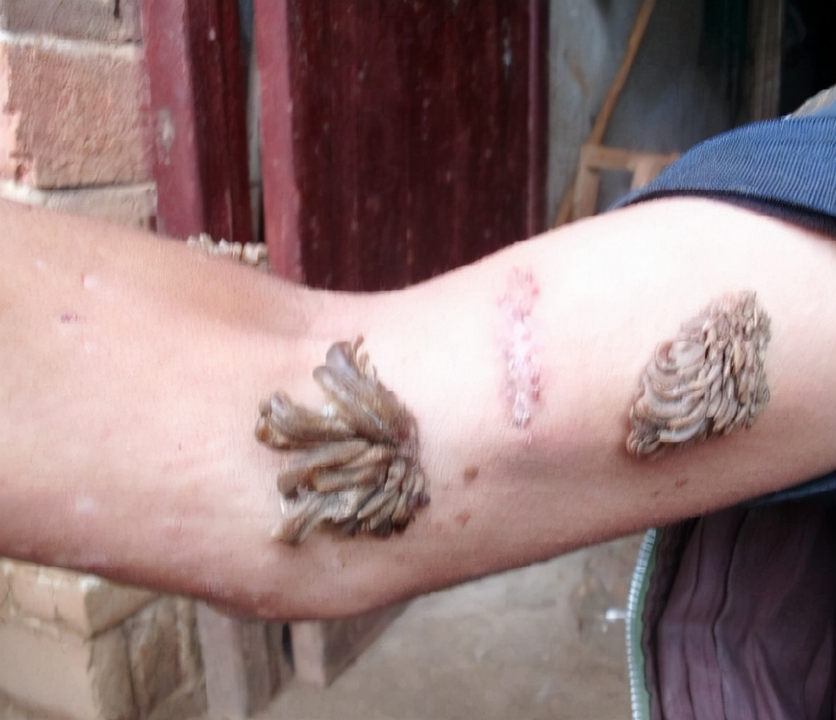 男子手长满树疙瘩是什么病,男子手长满树疙瘩手术了吗