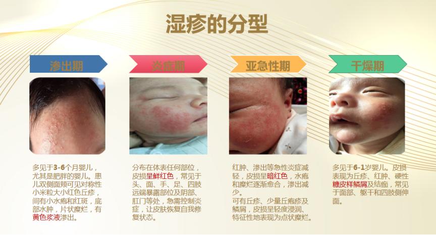 宝宝湿疹一直反复怎么断根,宝宝湿疹反反复复如何彻底根除