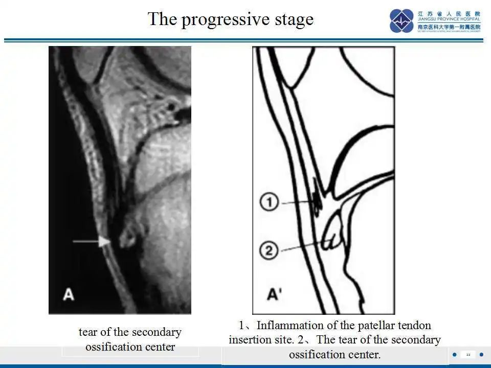 胫骨结节软骨炎要怎么治疗,胫骨结节骨软骨炎会癌变吗