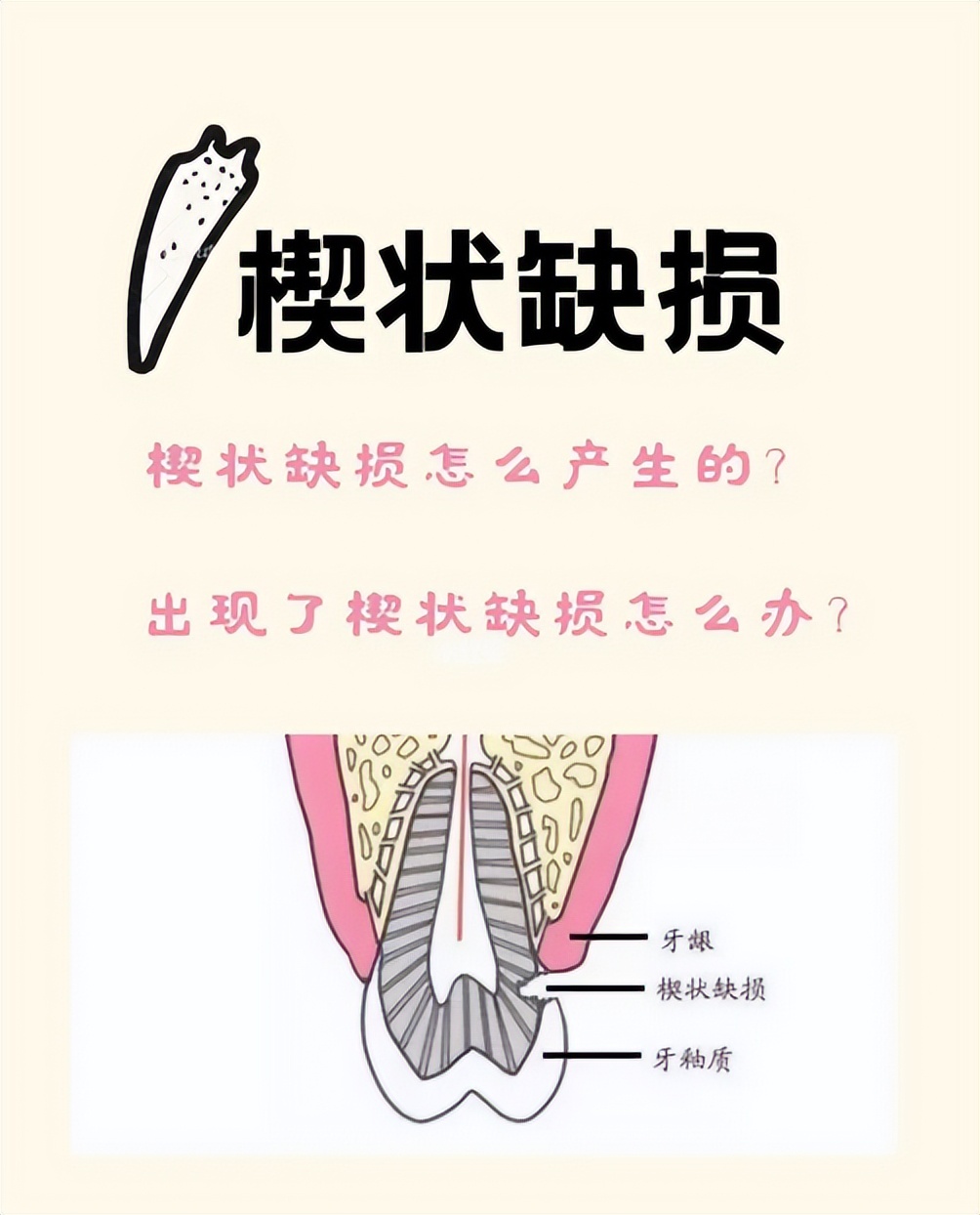 楔状缺损轻重症状,牙齿颈部楔状缺损怎么治