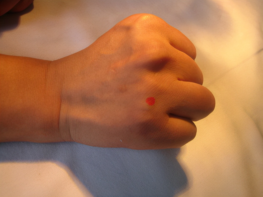 平衡针灸的深度解析图片大全,平衡针灸点穴视频