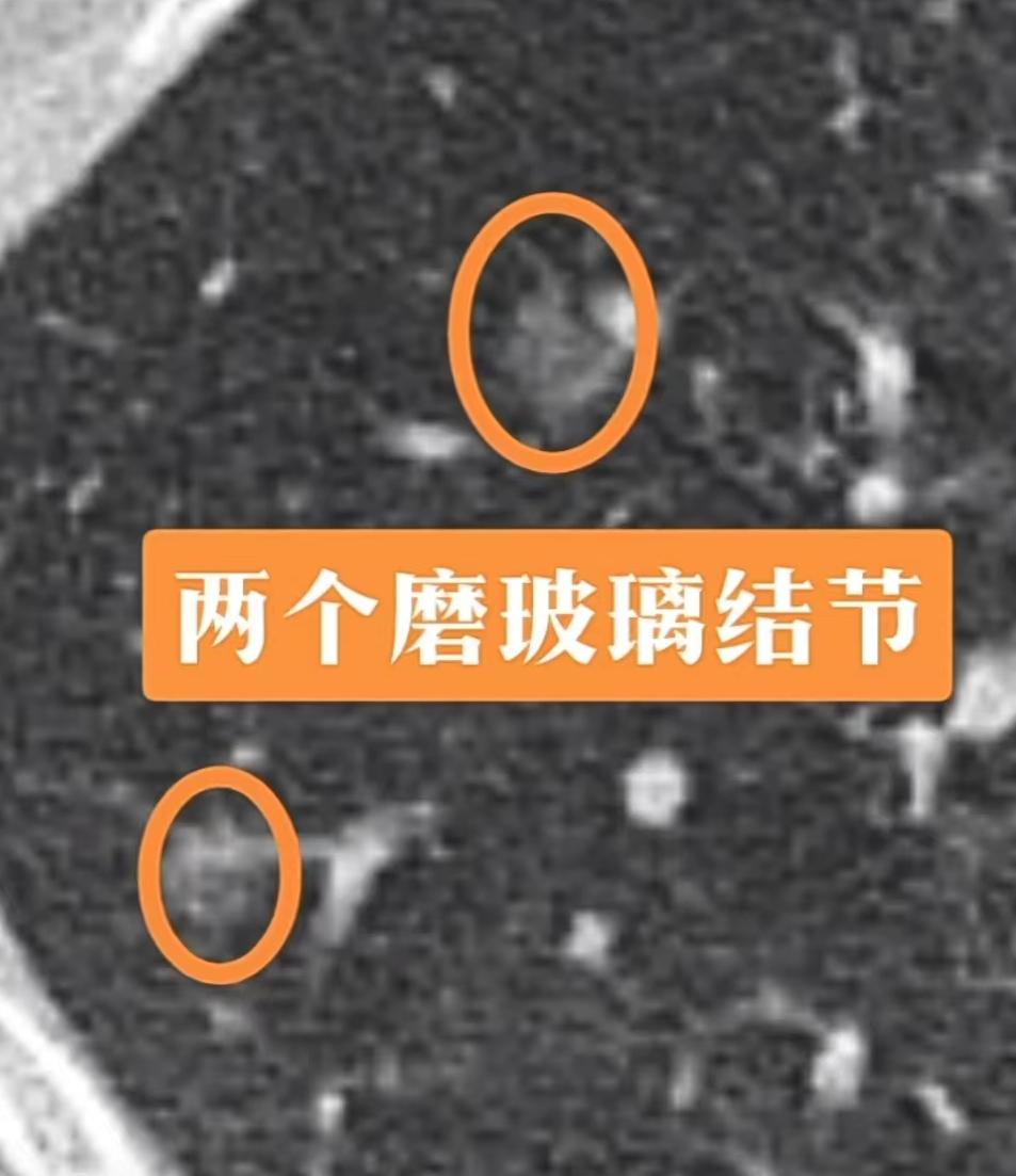 查出一个肺小结节很焦虑,查出肺结节这2件事您必须要知道