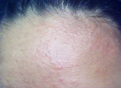 额头反复长小颗粒,额头密密麻麻的小颗粒怎么办